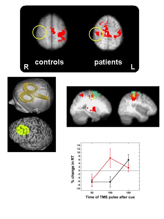 TMS in stroke
