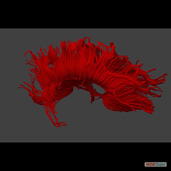 corpus callosum in red