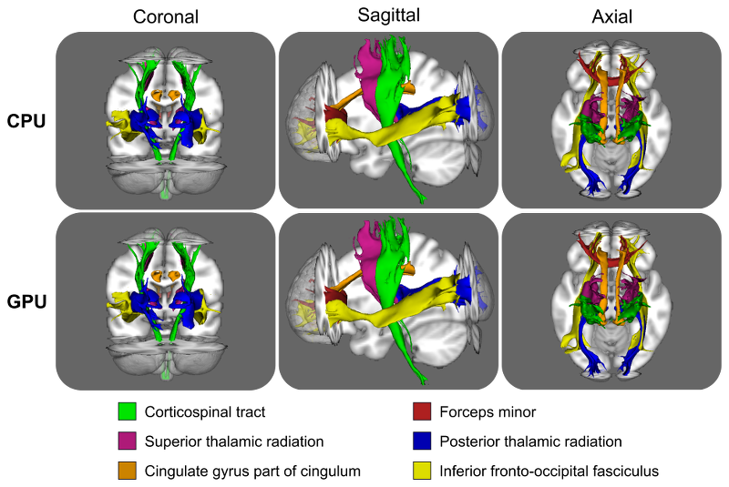 Reconstruction of white matter tracts using ProbtrackxGPU