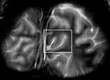 Coronal image through the striate cortex
